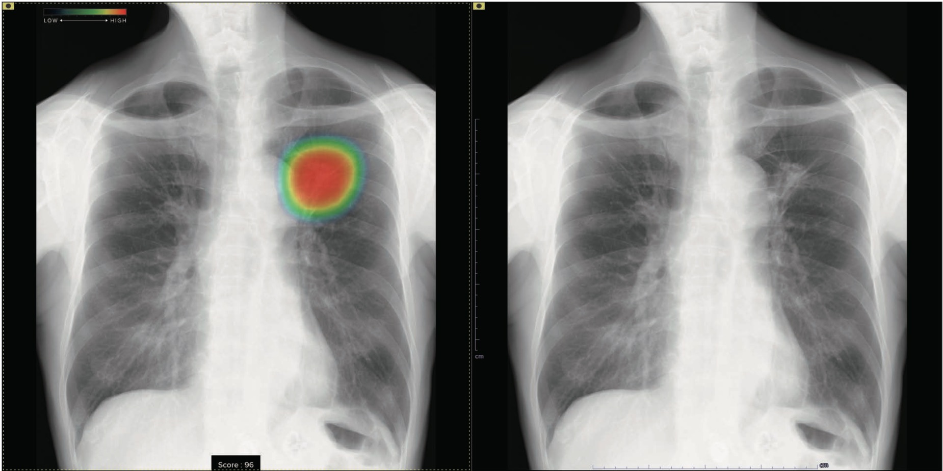 胸部X線画像病変検出ソフトウェア